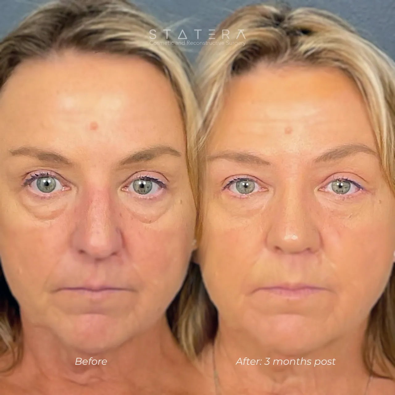 Lower Blepharoplasty