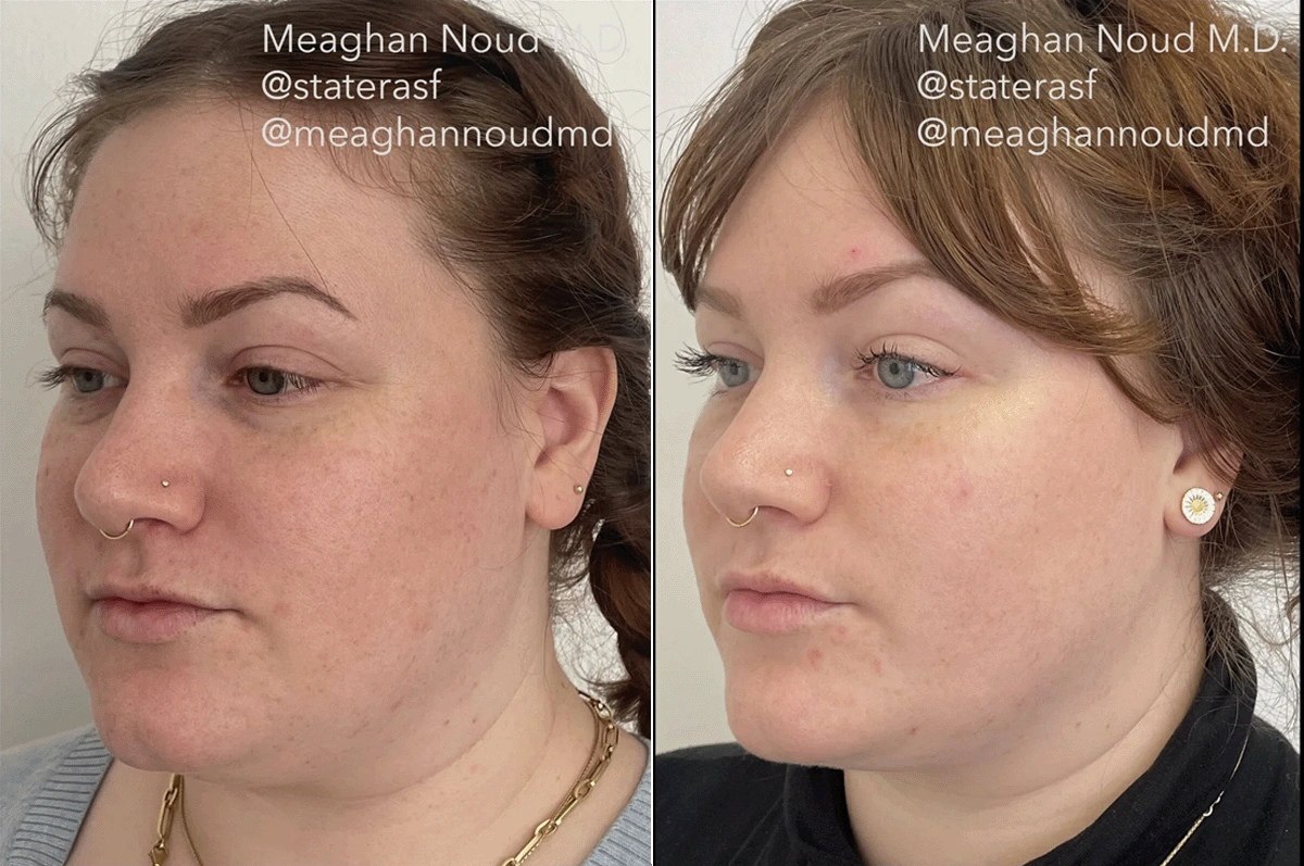 Real plastic surgery patient before and after results by Dr. Meaghan Noud in San Francisco, CA.