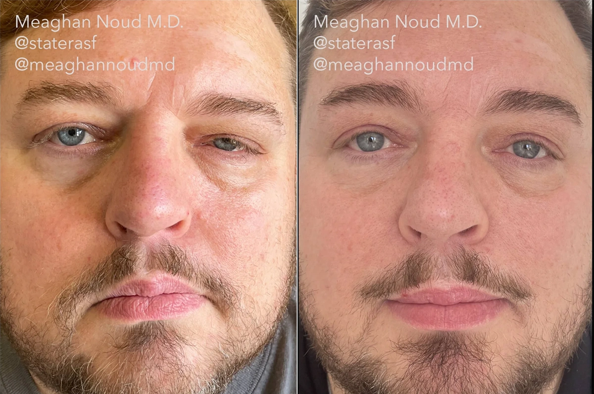 Real plastic surgery patient before and after results by Dr. Meaghan Noud in San Francisco, CA.