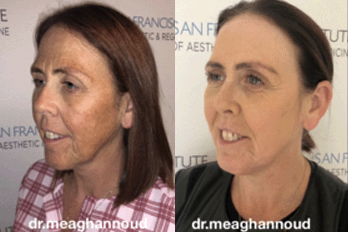 Real plastic surgery patient before and after results by Dr. Meaghan Noud in San Francisco, CA.
