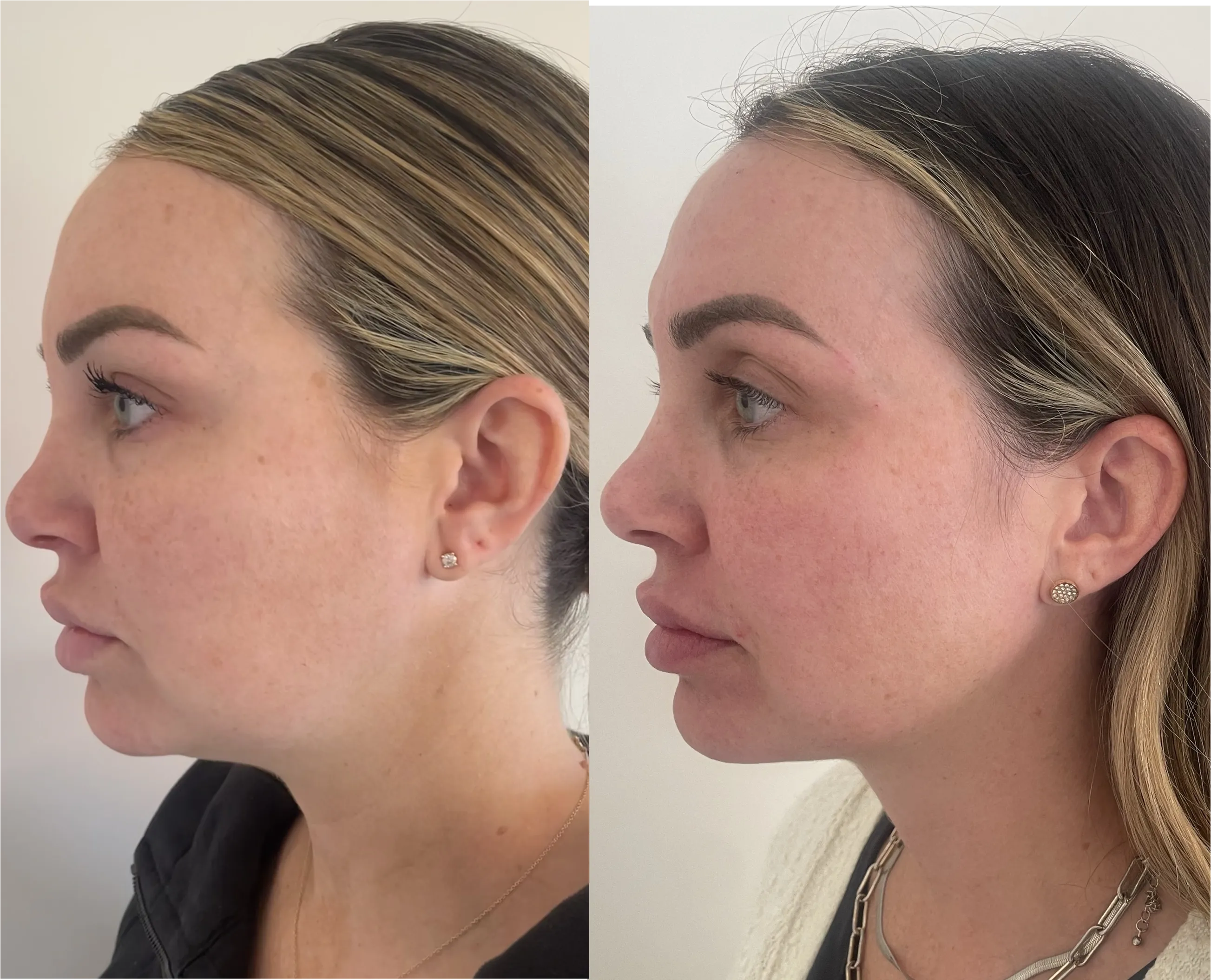 chin lipo, filler