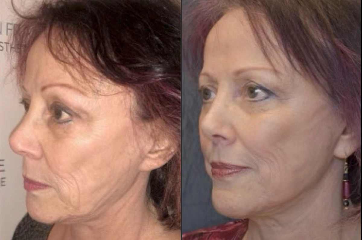 Real plastic surgery patient before and after results by Dr. Meaghan Noud in San Francisco, CA.