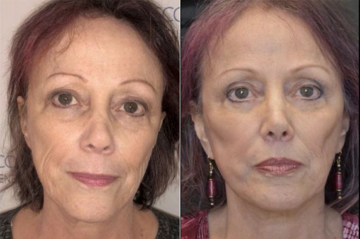 Real plastic surgery patient before and after results by Dr. Meaghan Noud in San Francisco, CA.