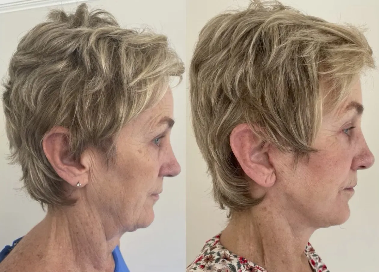 facelift and necklift cropped