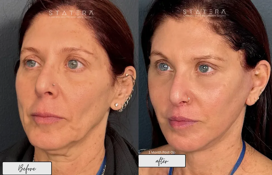 facelift, browlift, lip lift, chemical peel