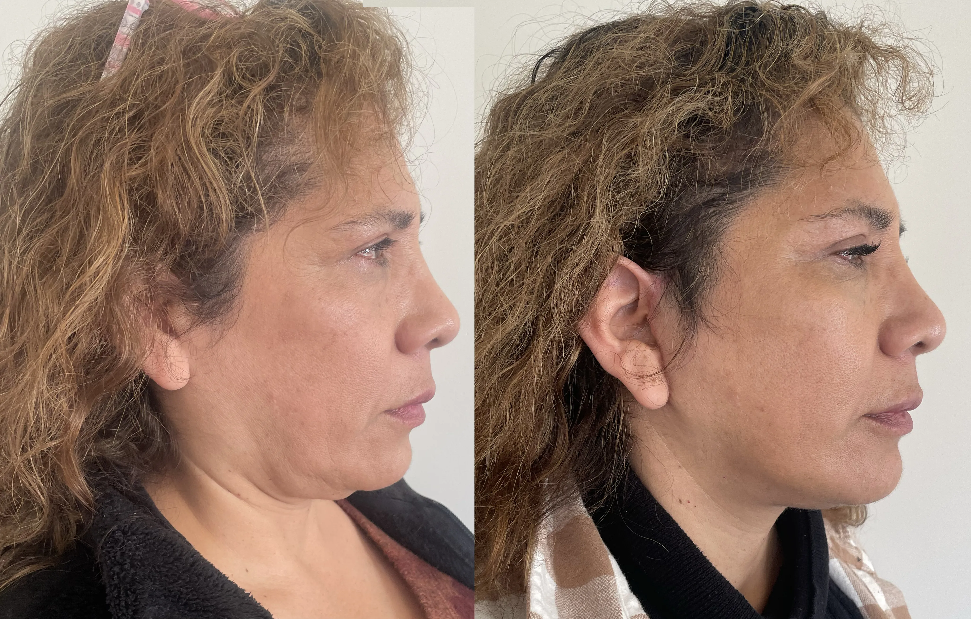 facelift, necklift 2