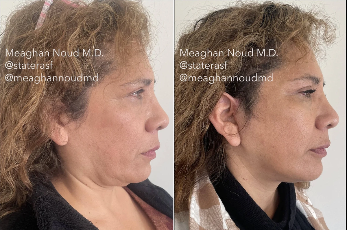 Real plastic surgery patient before and after results by Dr. Meaghan Noud in San Francisco, CA.