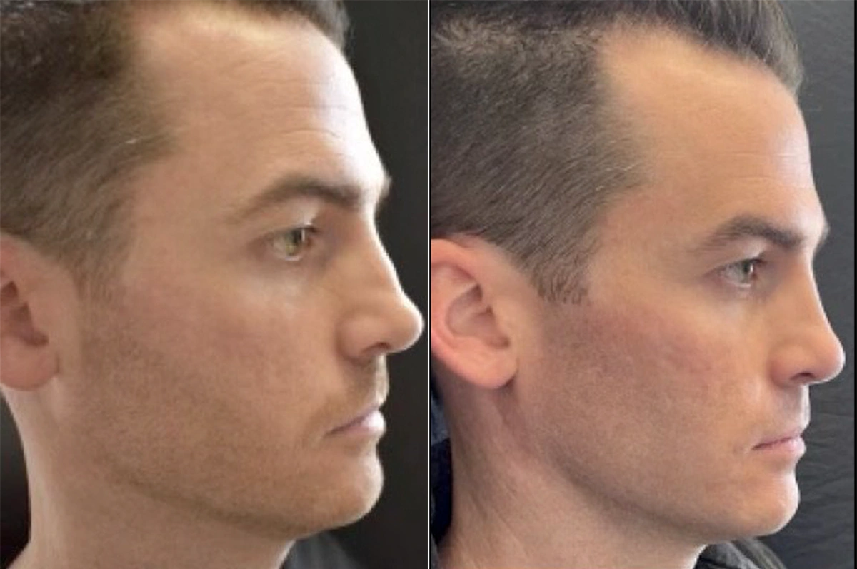 Real plastic surgery patient before and after results by Dr. Meaghan Noud in San Francisco, CA.
