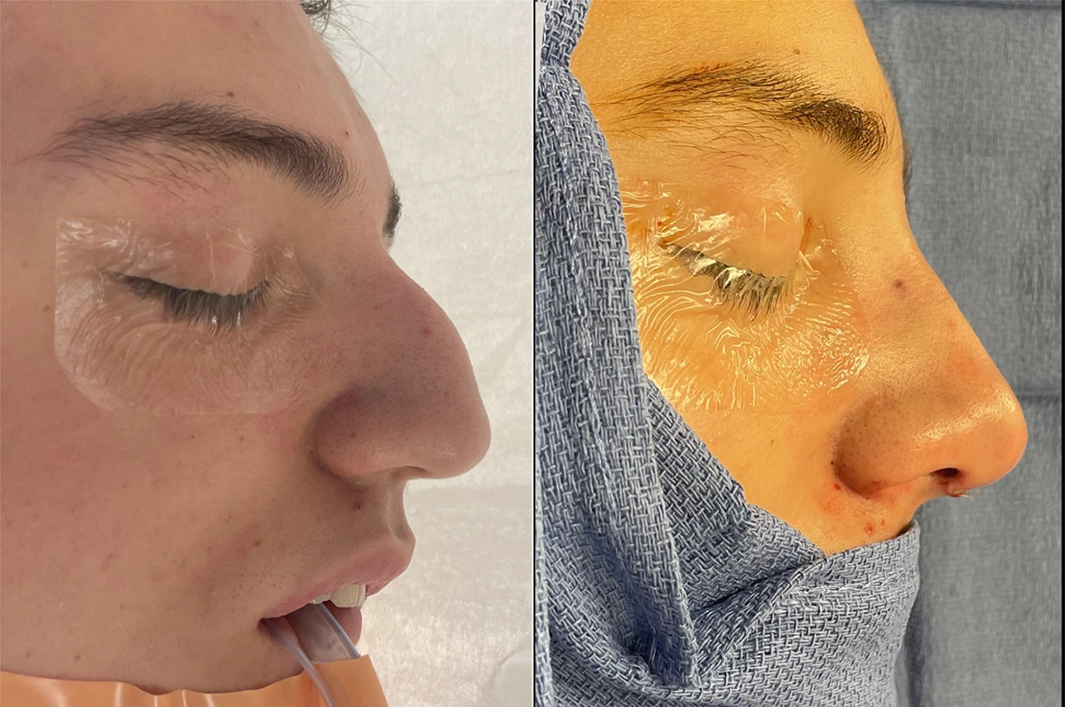 Real plastic surgery patient before and after results by Dr. Meaghan Noud in San Francisco, CA.