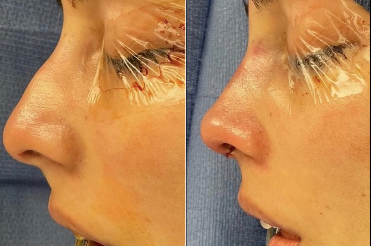 Real plastic surgery patient before and after results by Dr. Meaghan Noud in San Francisco, CA.