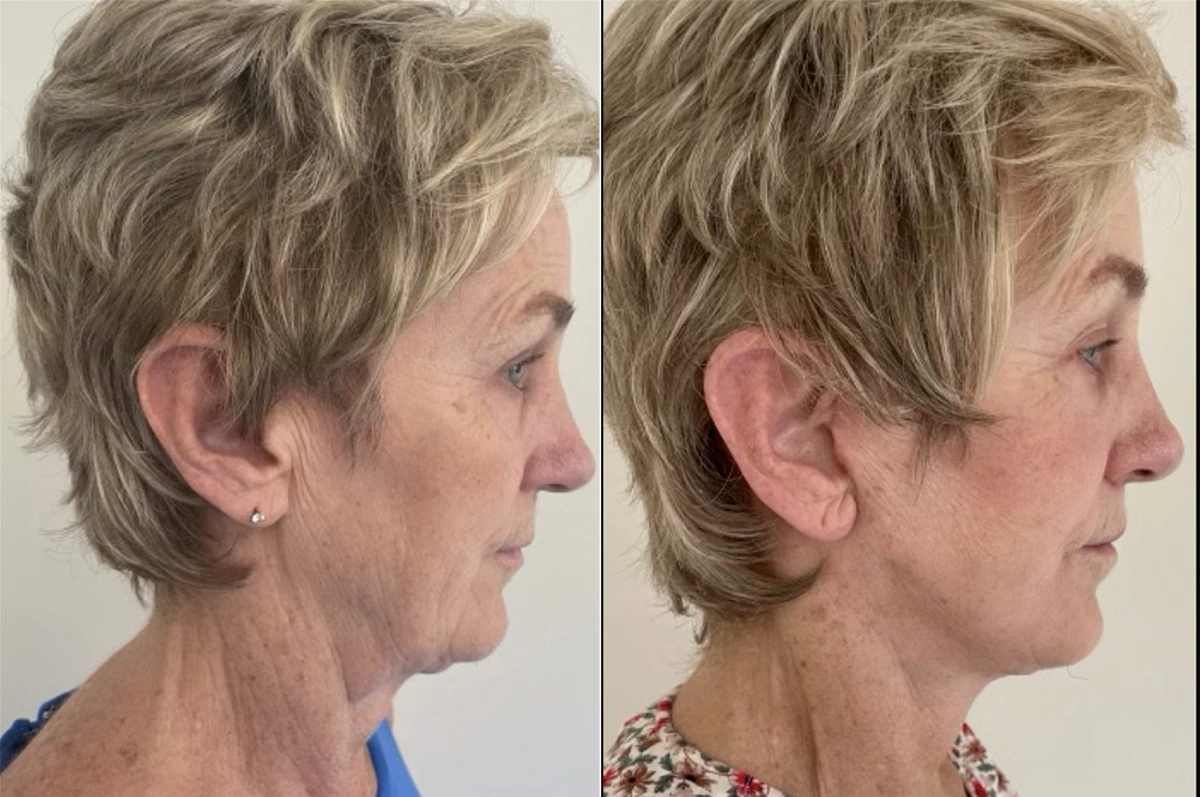 Real plastic surgery patient before and after results by Dr. Meaghan Noud in San Francisco, CA.