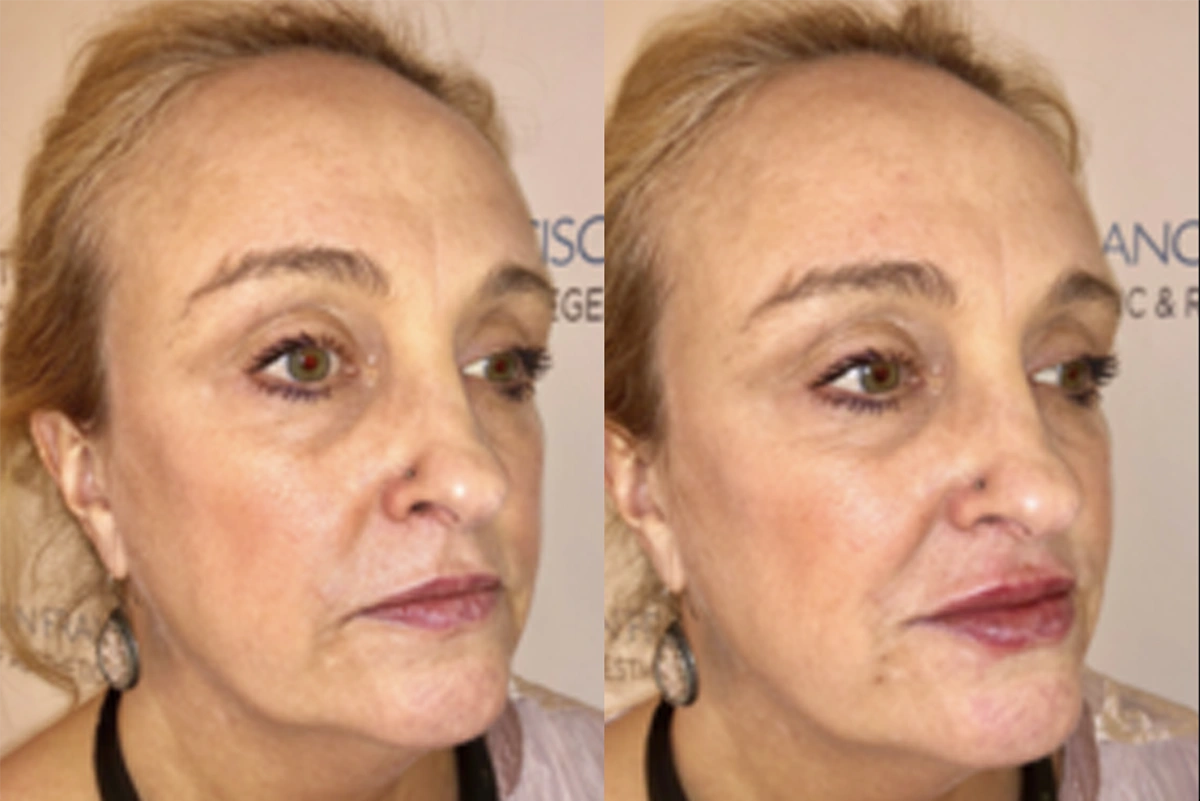 Real plastic surgery patient before and after results by Dr. Meaghan Noud in San Francisco, CA.