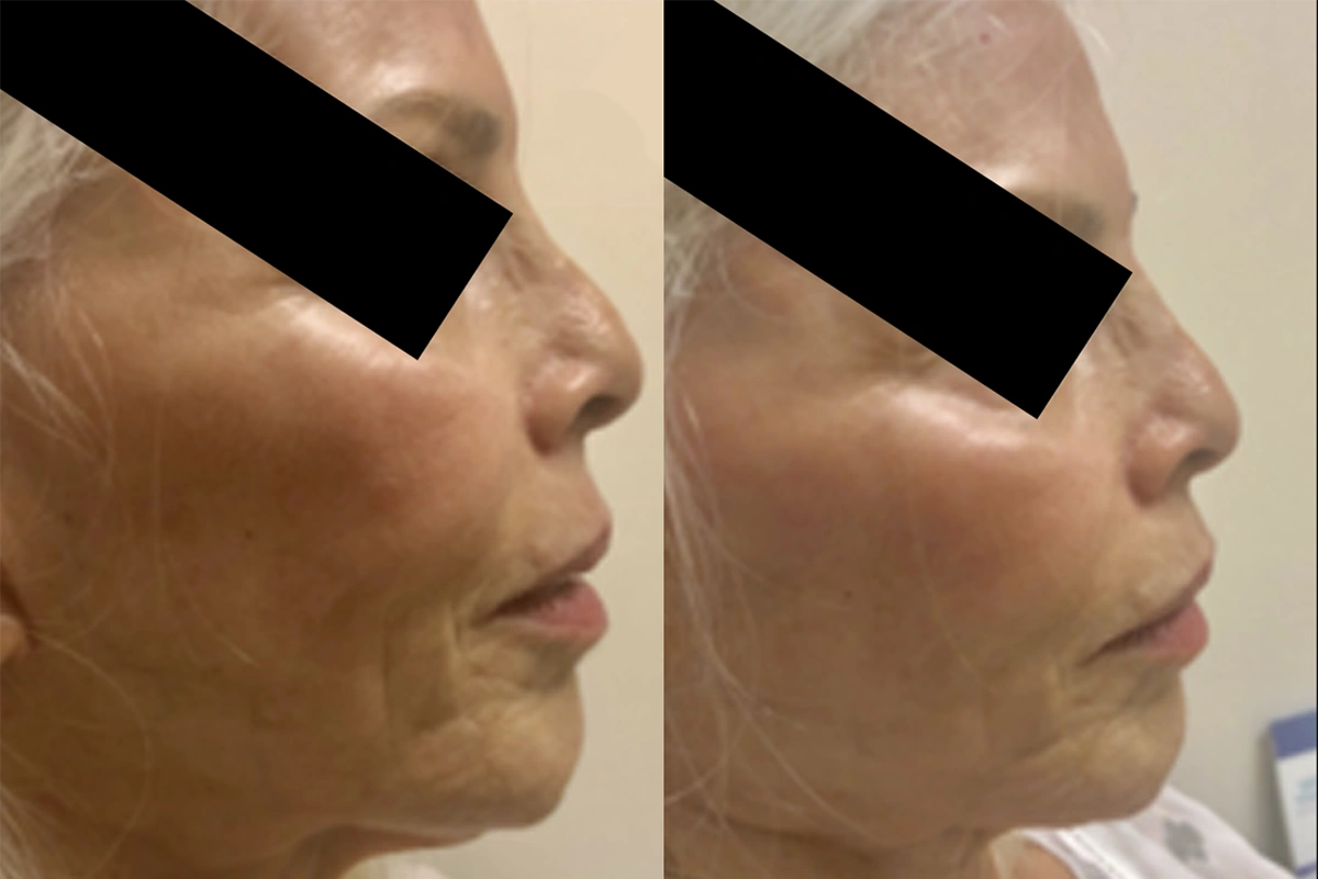 Real plastic surgery patient before and after results by Dr. Meaghan Noud in San Francisco, CA.