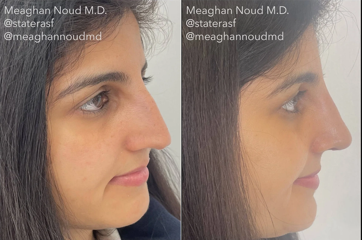 Real plastic surgery patient before and after results by Dr. Meaghan Noud in San Francisco, CA.