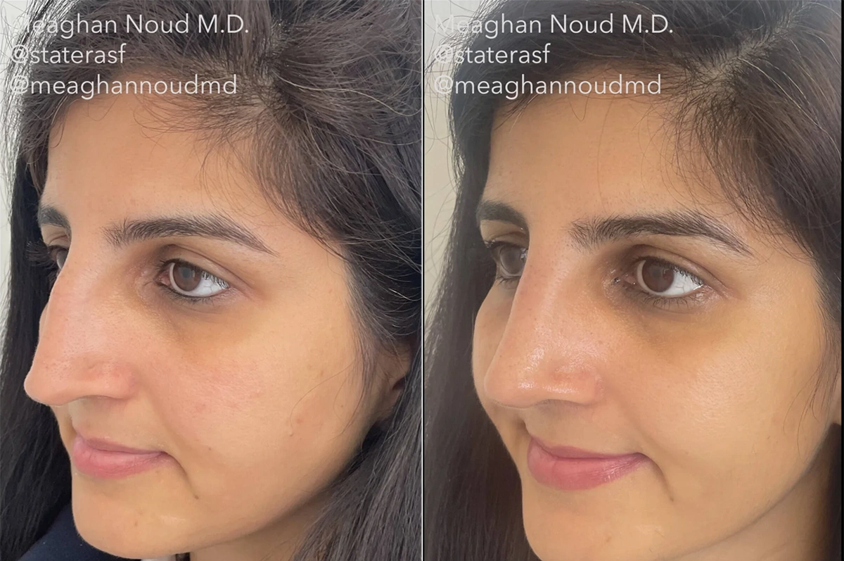 Real plastic surgery patient before and after results by Dr. Meaghan Noud in San Francisco, CA.