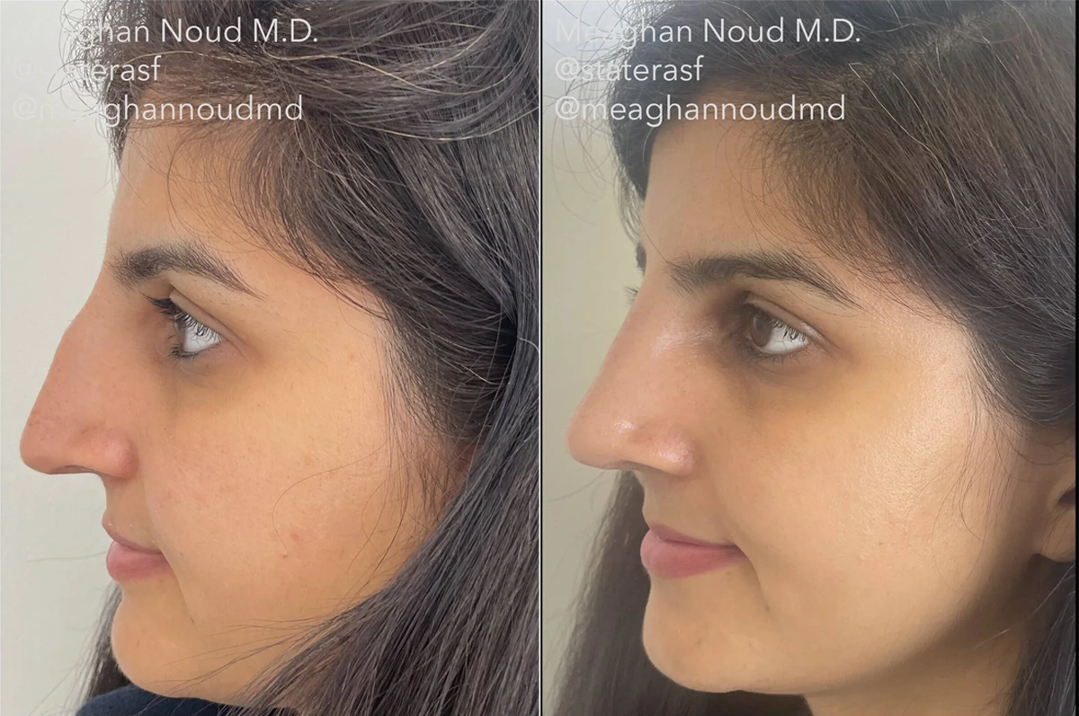 Real plastic surgery patient before and after results by Dr. Meaghan Noud in San Francisco, CA.