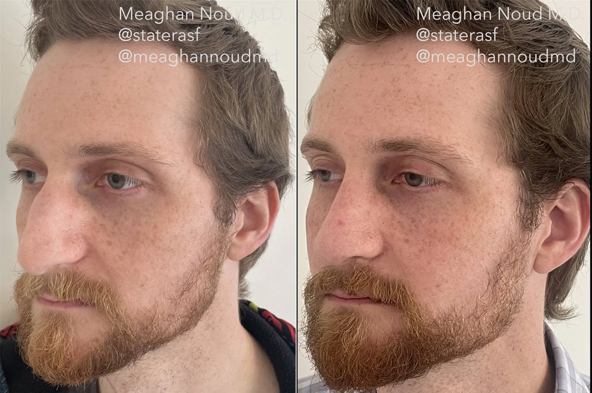 Real plastic surgery patient before and after results by Dr. Meaghan Noud in San Francisco, CA.