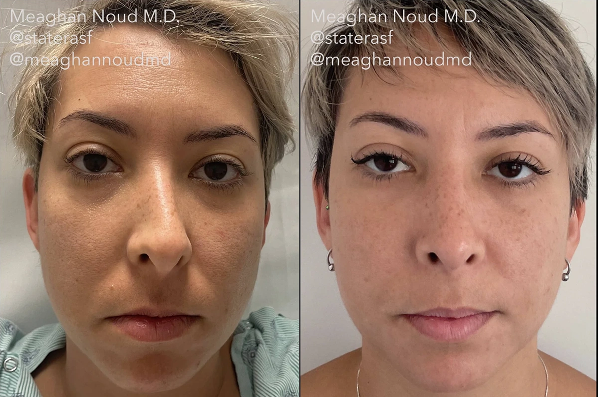 Real plastic surgery patient before and after results by Dr. Meaghan Noud in San Francisco, CA.