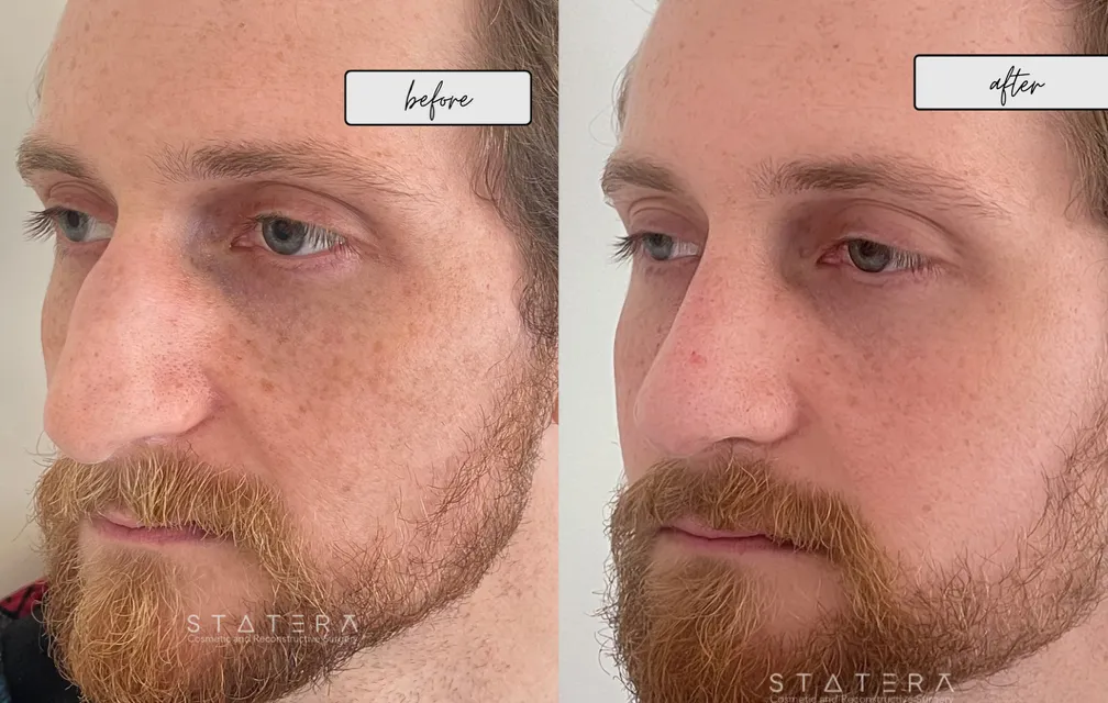 rhinoplasty