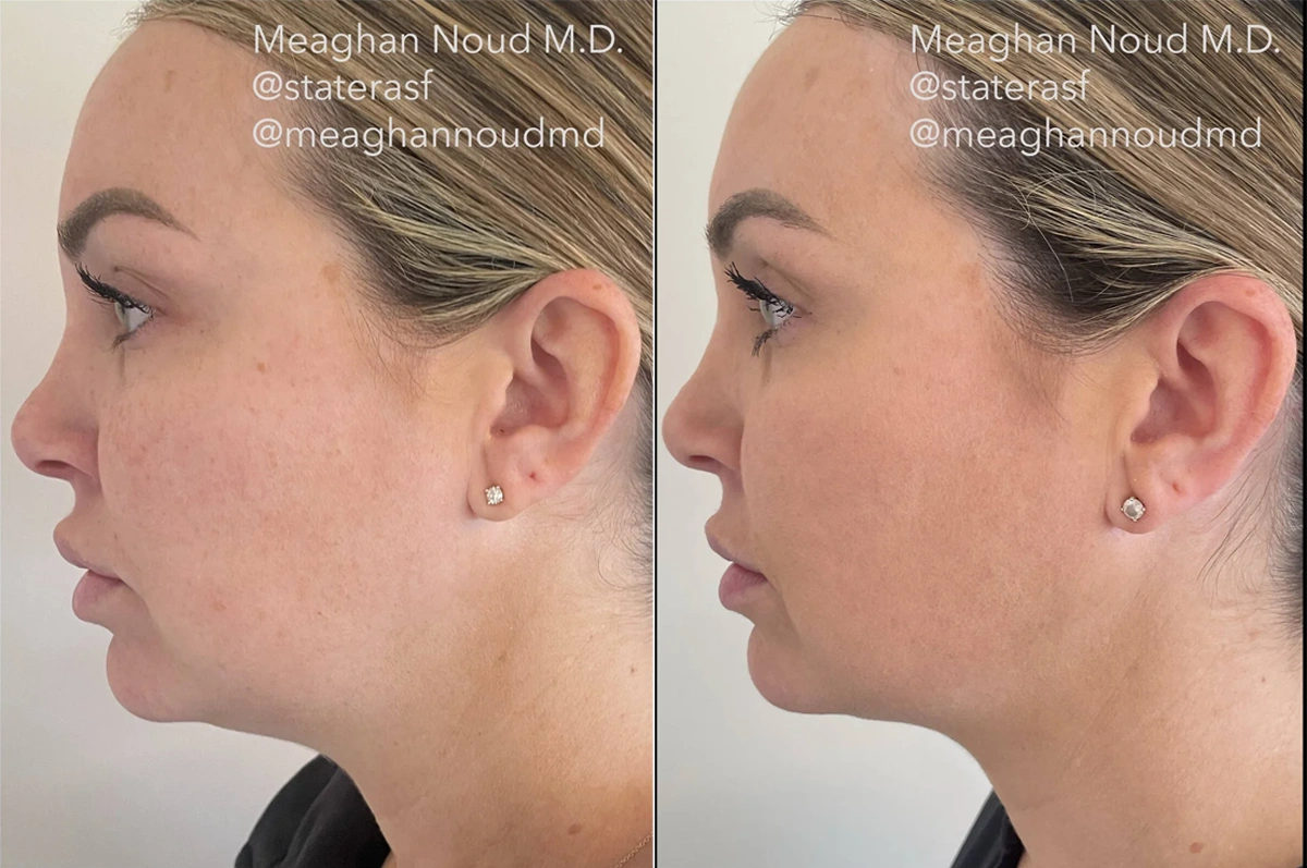 Real plastic surgery patient before and after results by Dr. Meaghan Noud in San Francisco, CA.