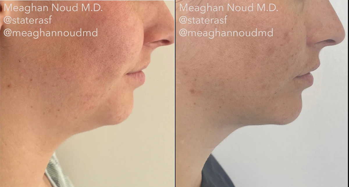 Real plastic surgery patient before and after results by Dr. Meaghan Noud in San Francisco, CA.