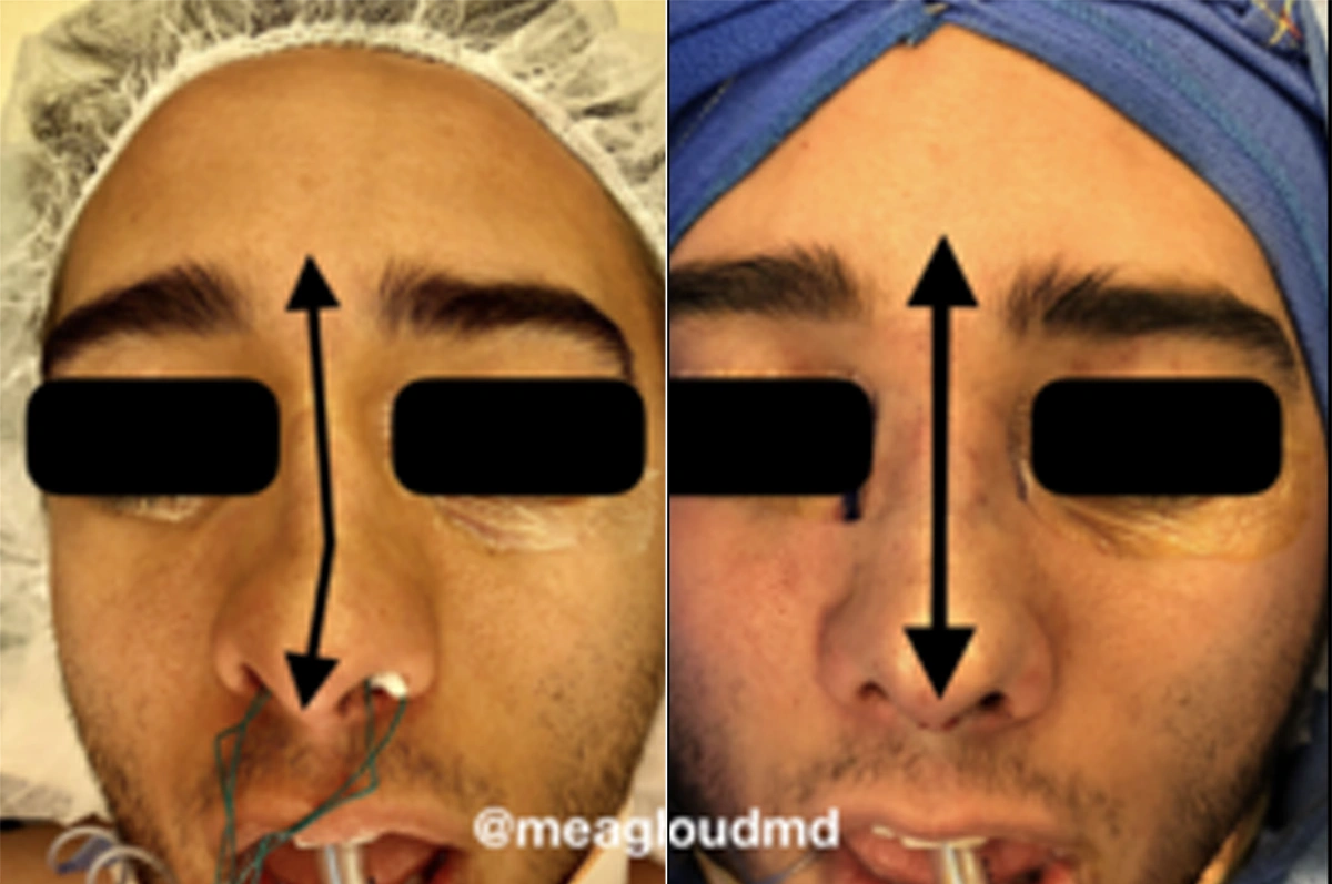 Real plastic surgery patient before and after results by Dr. Meaghan Noud in San Francisco, CA.