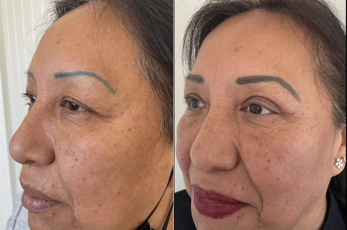 Real plastic surgery patient before and after results by Dr. Meaghan Noud in San Francisco, CA.