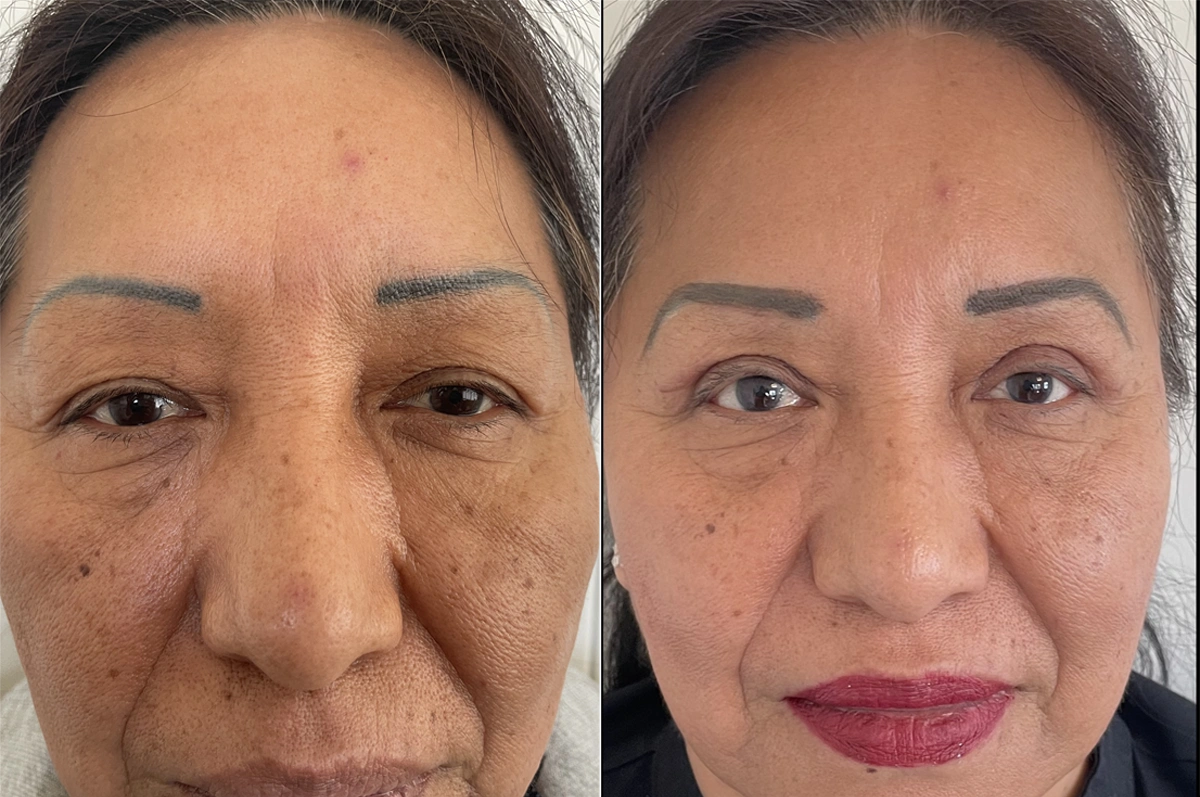 Real plastic surgery patient before and after results by Dr. Meaghan Noud in San Francisco, CA.