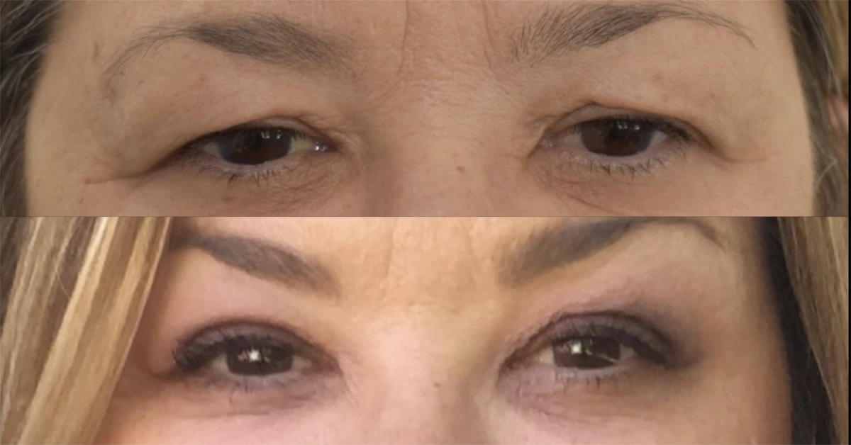 Real plastic surgery patient before and after results by Dr. Meaghan Noud in San Francisco, CA.