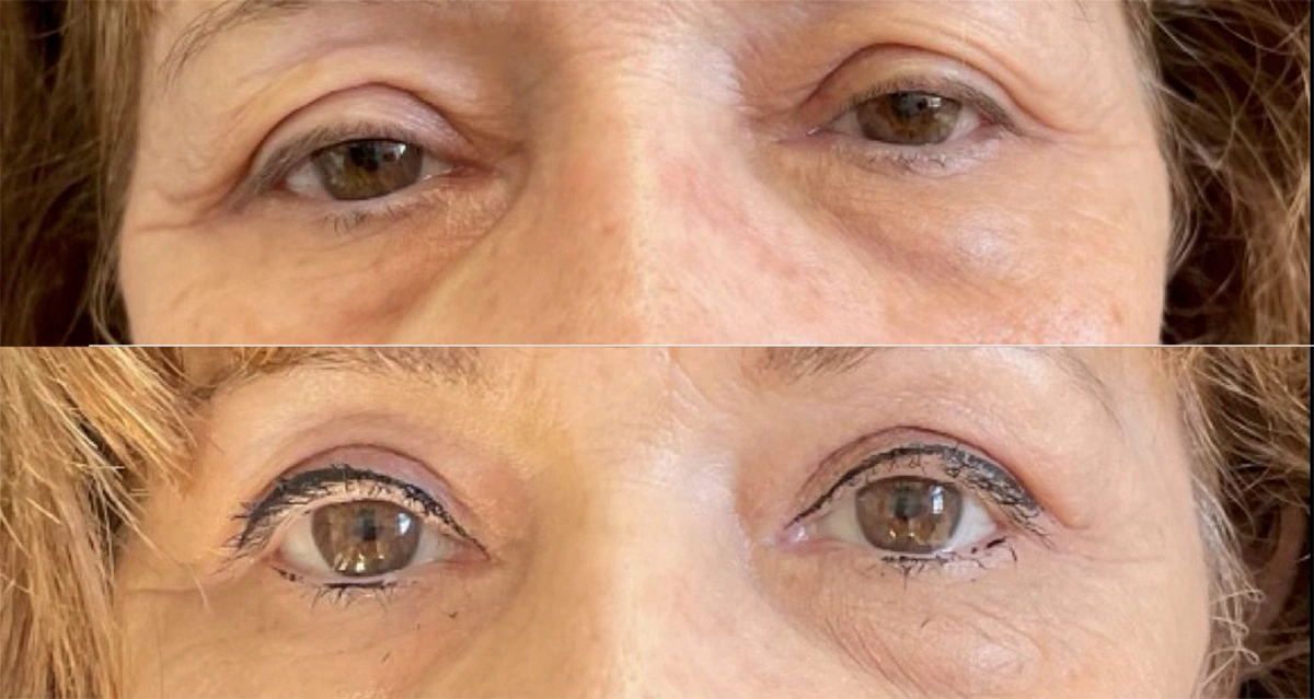 Real plastic surgery patient before and after results by Dr. Meaghan Noud in San Francisco, CA.