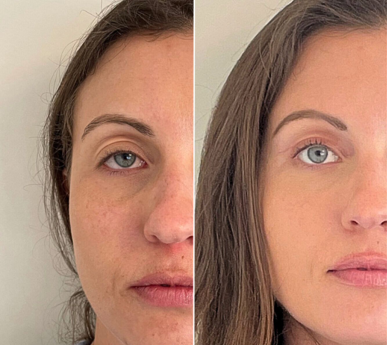 Lid cover pupil – 4