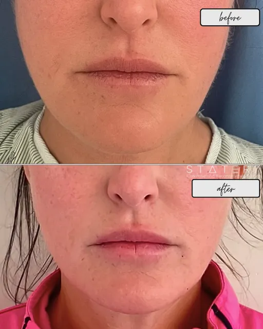 buccal fat removal